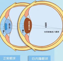 治疗白内障，别等“熟”了再做打算