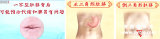 “肚脐”变成这3种形状，注意心脏、脾胃的健康问题