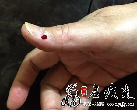 少商放血准确图