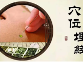 穴位埋线方法
