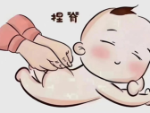捏脊：振奋阳气 调整脏腑